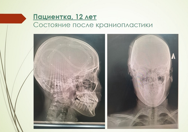    В Кирове врачи бьют тревогу из-за роста детского травматизма на мототранспорте и СИМ