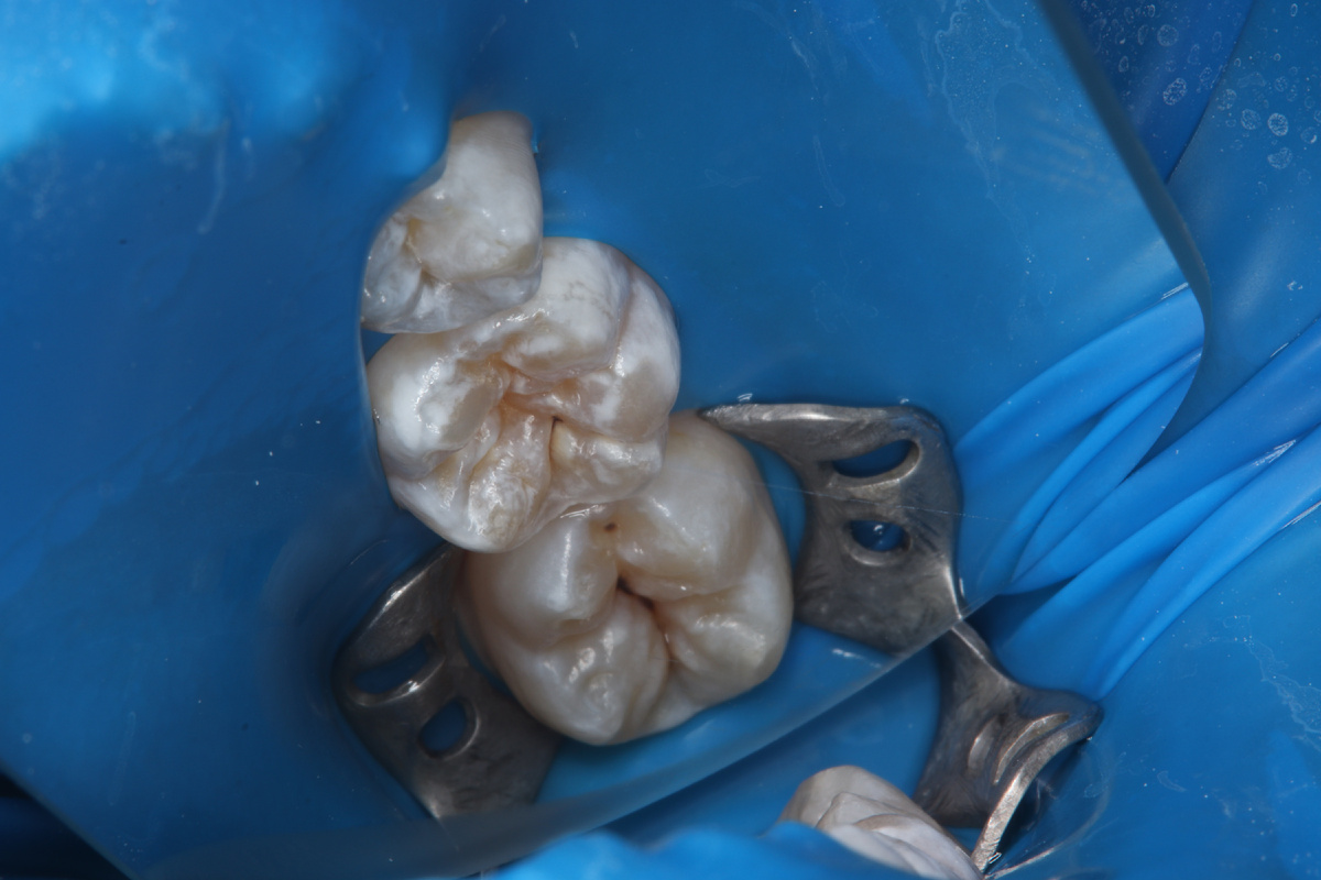 Так выглядят те самые бороздки-фиссуры у ребёнка: некоторые из них довольно глубокие.