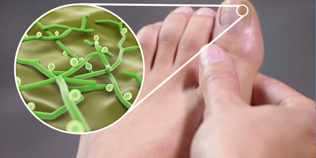 Чем опасны грибковые инфекции, и как не упустить момент