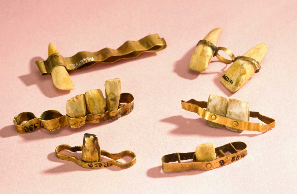 Этруски показывают, как они устанавливали удаленные зубы без корней на золотые мосты, которые затем устанавливались между здоровыми зубами.