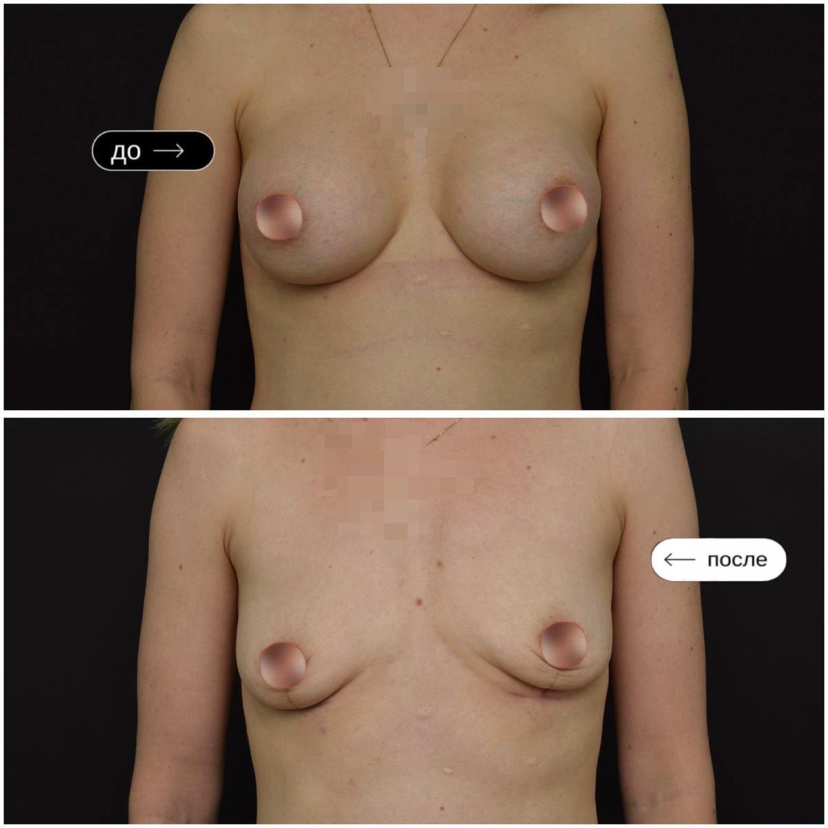 Грудь после удаления импланта с одномоментной подтяжкой. 