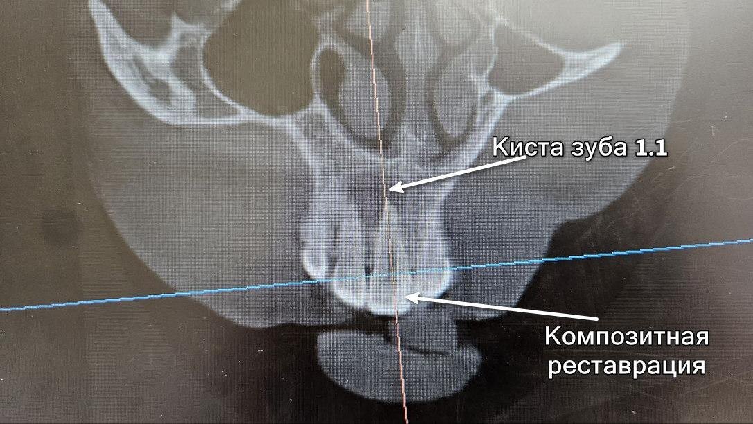 Киста зуба 1.1, которая уже распространилась на апекс зуба 1.2