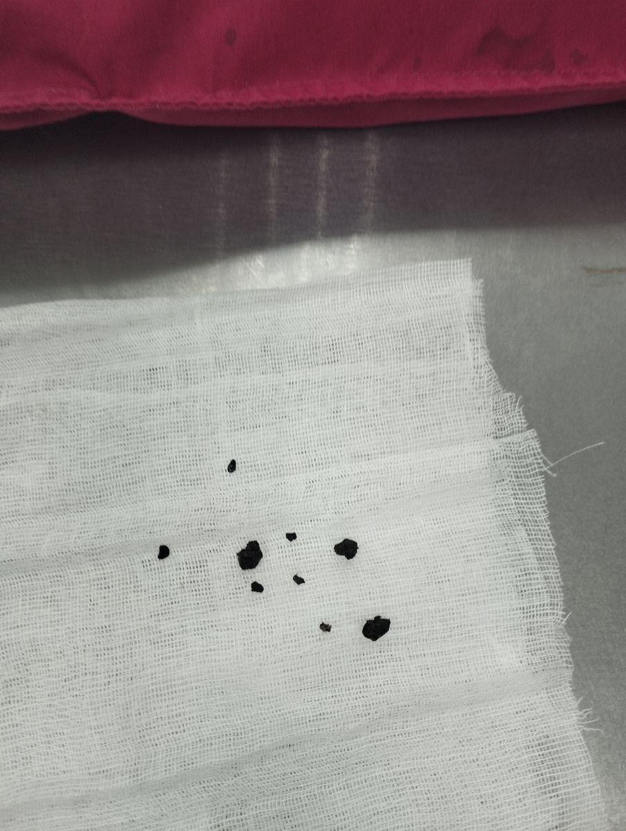 Что такое церуменолит? Это плотный, как камень, сухой кусочек серы. Почти тоже самое, что серная пробка у людей. Часто они образуются на фоне отодектоза или агрессивной чистки палочками, но бывают и идеопатическими, когда причина не выявлена.  Вот часть того, что достали только из одного уха.