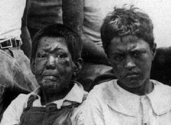 Гавайские дети с проказой.