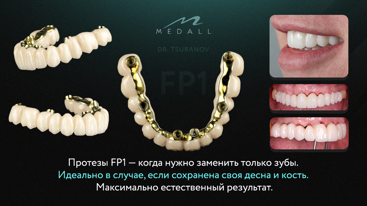 Работы стоматолога-ортопеда Цуранова Сергея Александровича