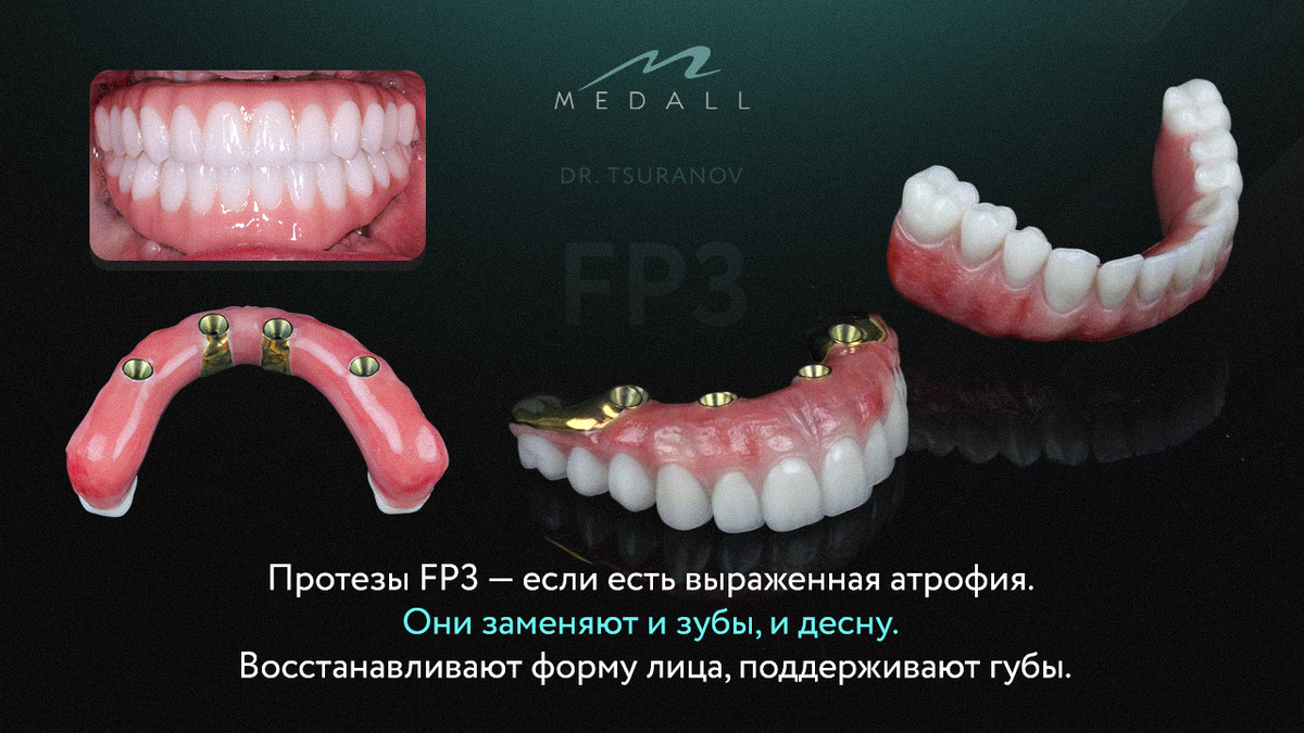 Работы стоматолога-ортопеда Цуранова Сергея Александровича
