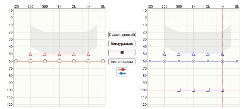 Пример. Одинаковые тональные пороги по воздушному и костному проведению и добавлены «измеренные» пороги дискомфорта слева.
