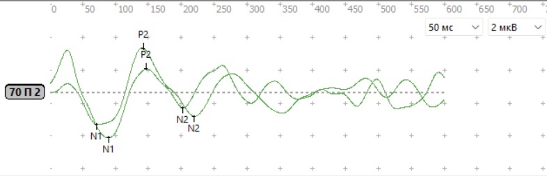 ДСВП у ребенка 5 лет — пик Р11 из 2