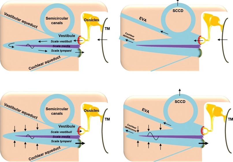 Схема работы внутреннего уха при воздушном и костном проведении в норме (слева) при наличии «третьего окна» (справа). Spectrum of Third Window Abnormalities: Semicircular Canal Dehiscence and Beyond X M.L. Ho, X G. Moonis, X C.F. Halpin, and X H.D. Curt