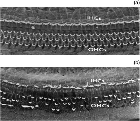 Сверху (а) неповрежденные ряды наружных и внутренних волосковых клеток, а снизу(b) потеря части как наружных так и внутренних волосковых клеток.