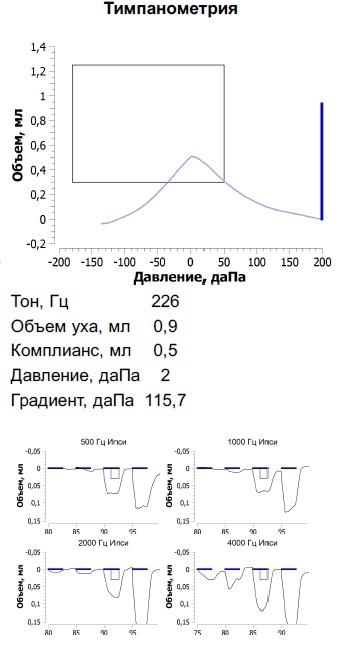 Тимпанометрия и акустические рефлексы