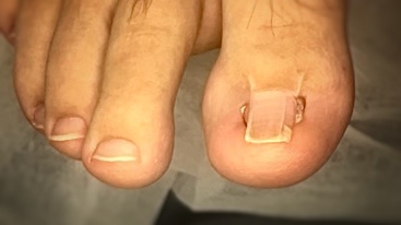 Метод радикального вмешательства после которого ноготь выглядит так