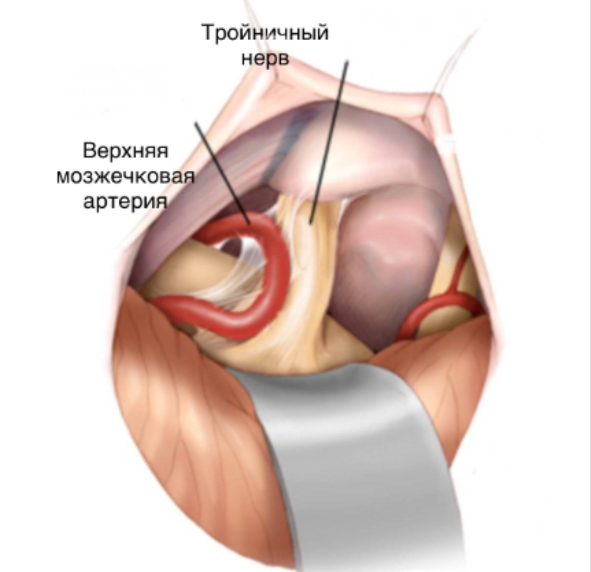 Схематичный пример нейроваскулярного конфликта - артерия давит на нерв 