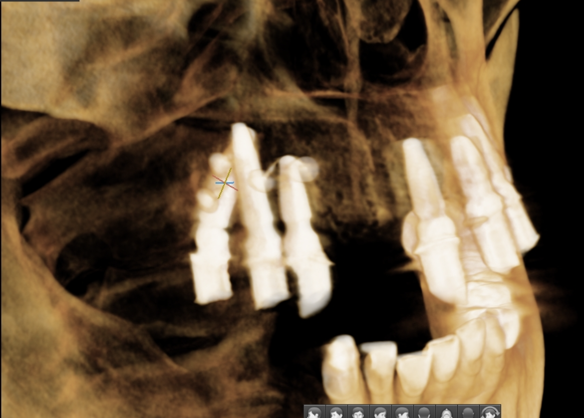 Видны шляпки пинов, которыми удерживается трансплантат десневой