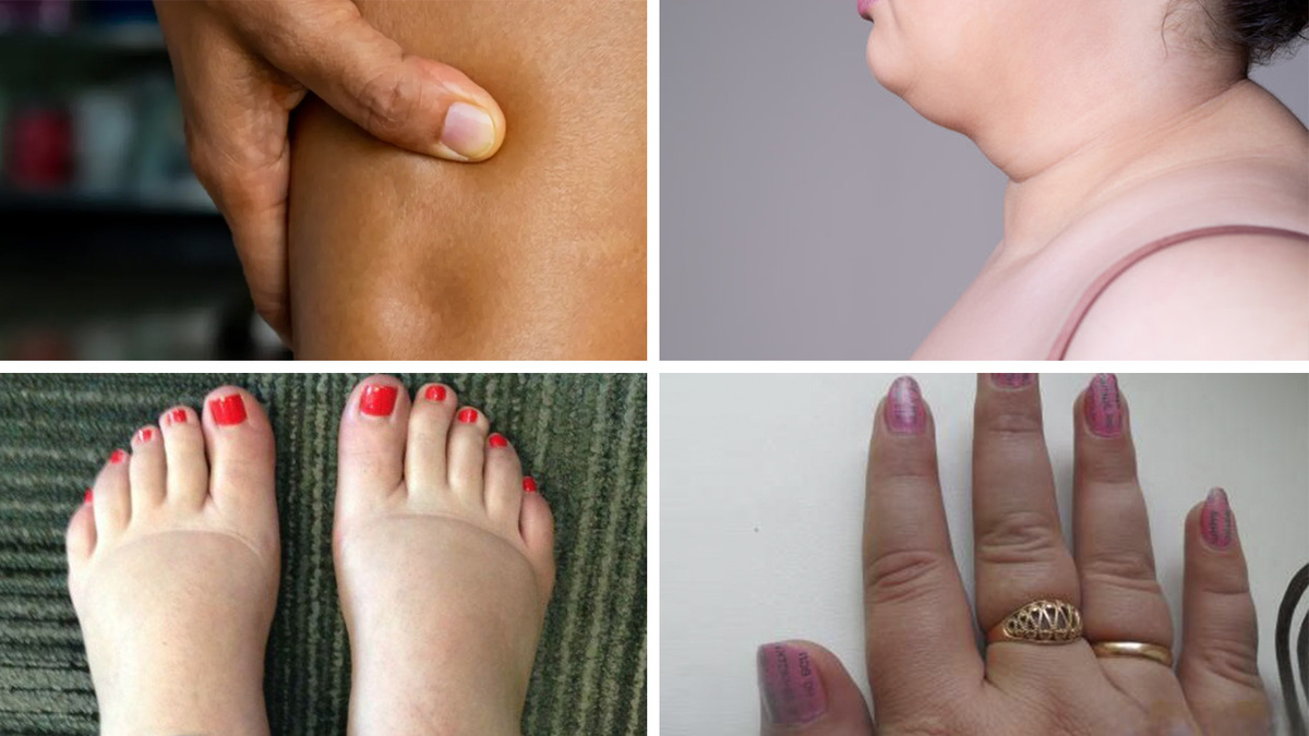 Провокаторы отеков — не только соль!