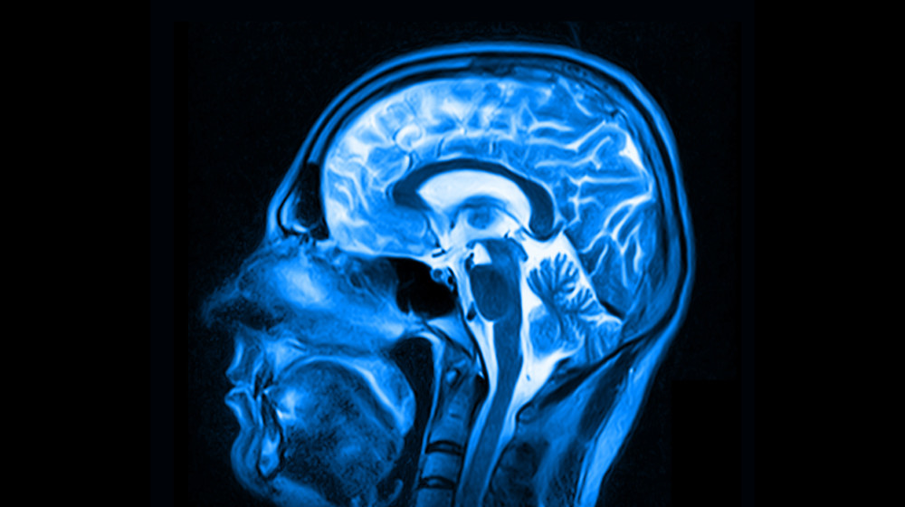    Женщина умерла от прионной болезни спустя 50 лет после зараженной инъекции