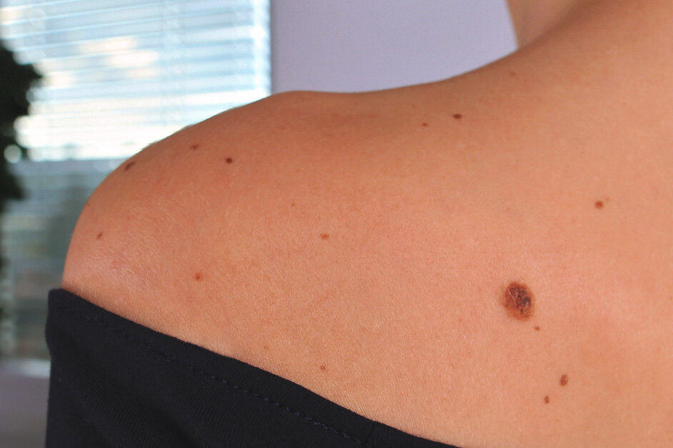    Почему у нас появляются родинки и когда они становятся опасными