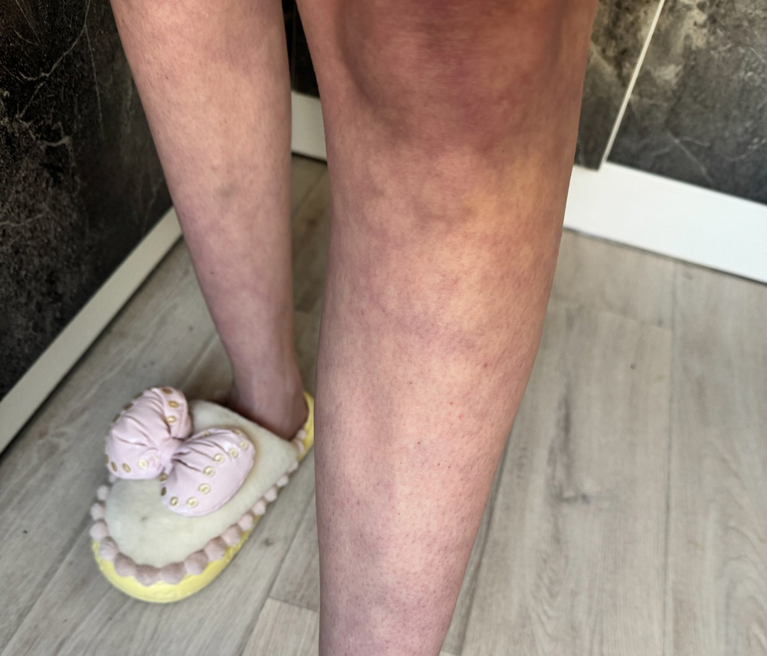 4 года не могут найти причину таких ног. 