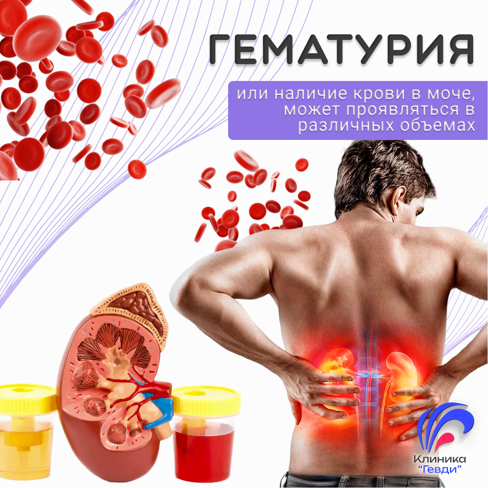 Гематурия, или наличие крови в моче. Лечение гематурии в Клинике "Гевди"