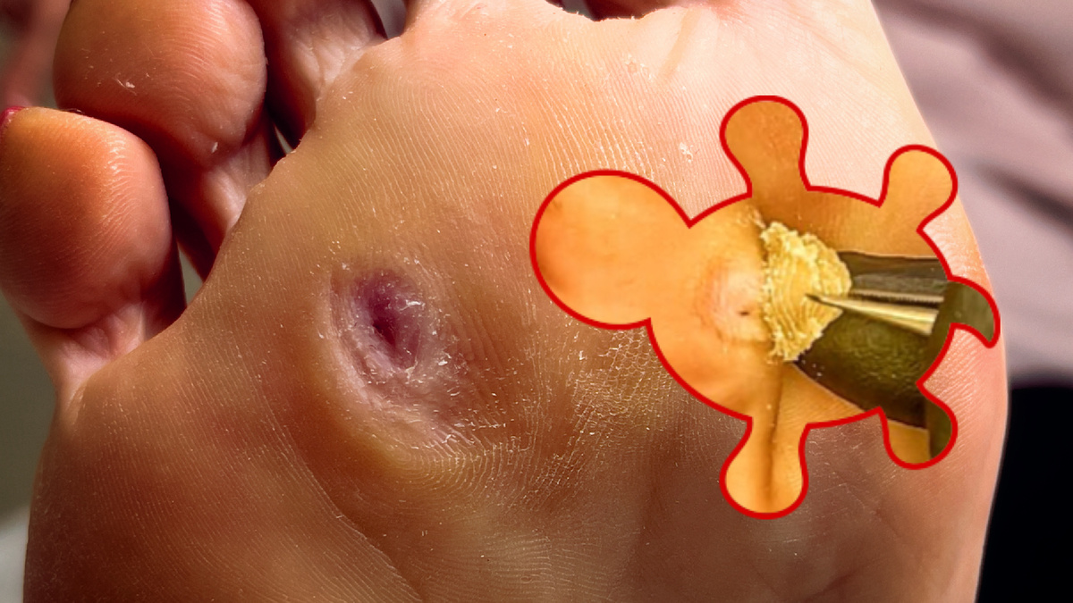 Очаг мозоли в зоне плюсны