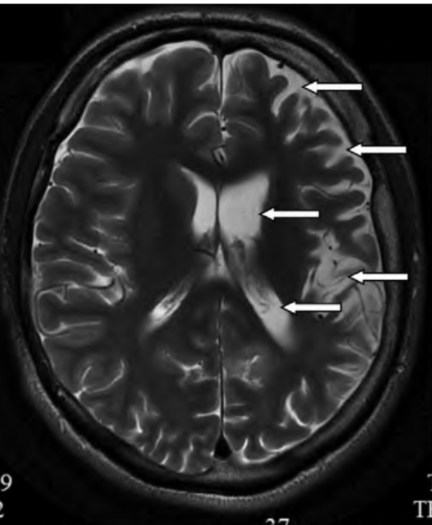 МРТ 7-летнего ребенка с данной формой энцефалита (пример из статьи Ващилина Т.С.): выражена асимметрия боковых желудочков, расширены субарахноидальные пространства 
