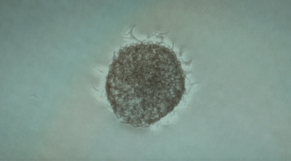 Что такое метастазы?