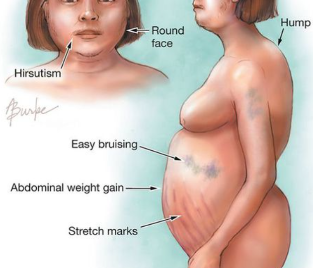 Гиперкортицизм, готов ли я к стрессу?