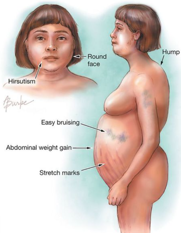 Характерные изменения при синдроме Кушинга