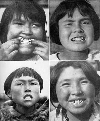 Лица деформированные современными продуктами питания