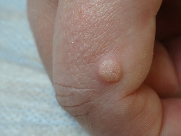 обыкновенная бородавка