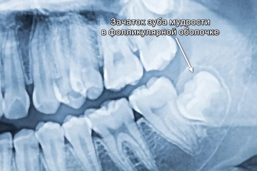 Зачаток зуба мудрости в фолликулярной оболочке