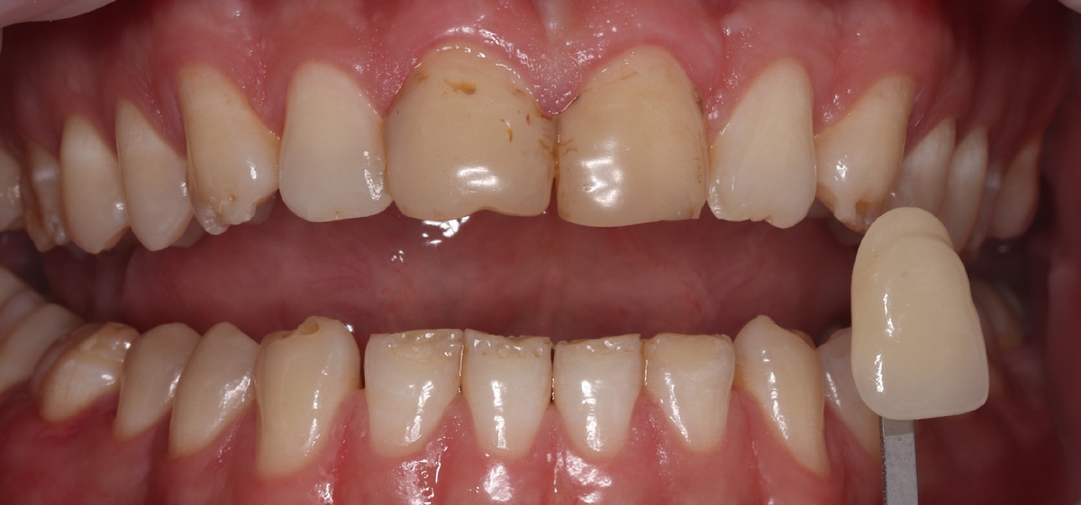 Перед отбеливанием врач определяет изначальный цвет эмали зубов пациента по шкале VITA и выбирает с пациентом желаемый результат.