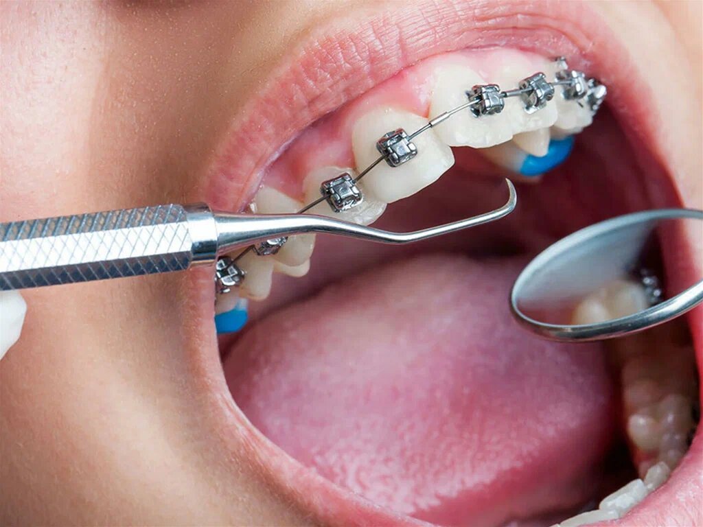 Ортодонтические синие накладки