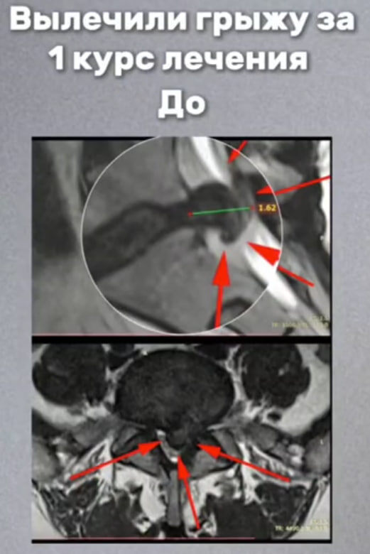 "ДО" грыжа L5-S1, сагиттальный размер 1,6 см, абсолютный стеноз канала