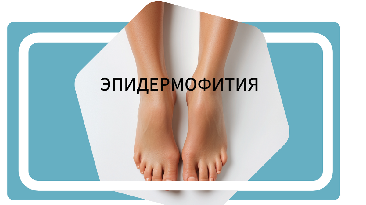 Эпидермофития: лечение и профилактика кожи, стоп и ногтей