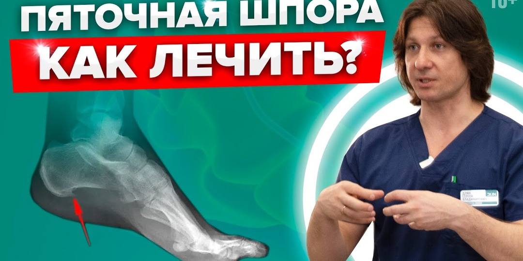 Пяточная шпора: Первые симптомы, как не упустить начало и что делать