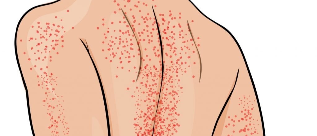 Тромбоцитопеническая пурпура (ТПшка)