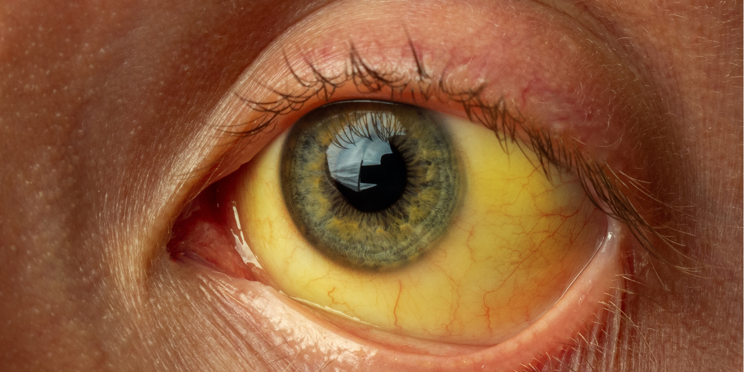 Гепатит C: «молчаливый убийца», которого можно победить