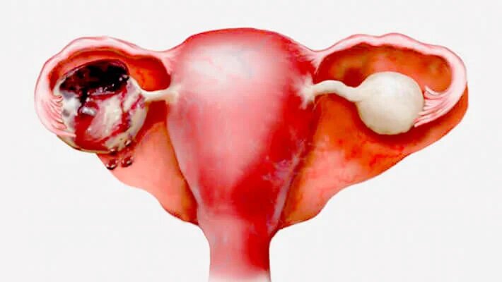 аоплексия яичника