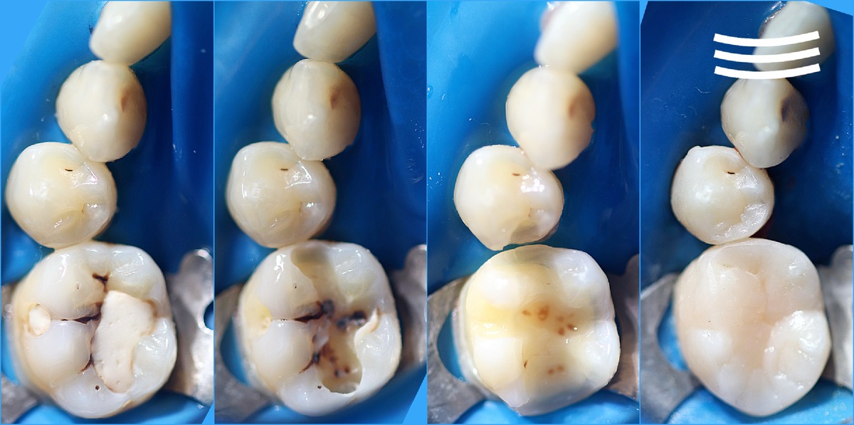 Лечение кариеса дентина 45,46 зубов