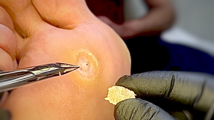 Рубцовая ткань под основанием сухой плотной мозоли