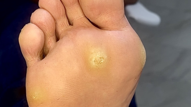 Диаметр плотной мозоли 1,5 см