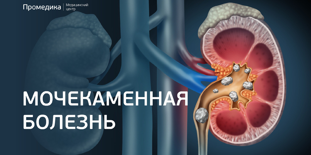 Мочекаменная болезнь (МКБ): от лёгкого дискомфорта до невыносимой боли. Когда пора к врачу?