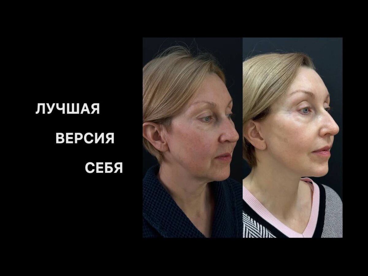 Выполнили smas-пластику нижней трети лица, платизмопластику, булхорн.