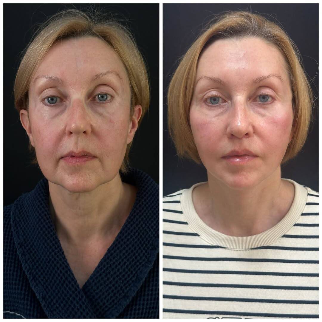 Выполнили smas-пластику нижней трети лица, платизмопластику, булхорн.