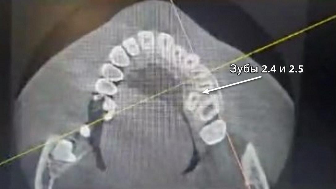 Дуга левой половины верхней челюсти изогнута неправильно, жевательные зубы смещены