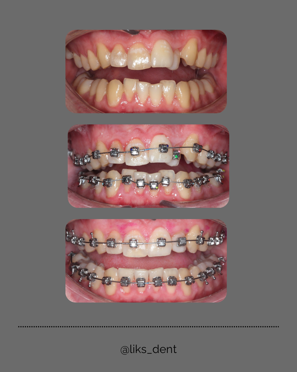 Процесс ортодонтического лечения