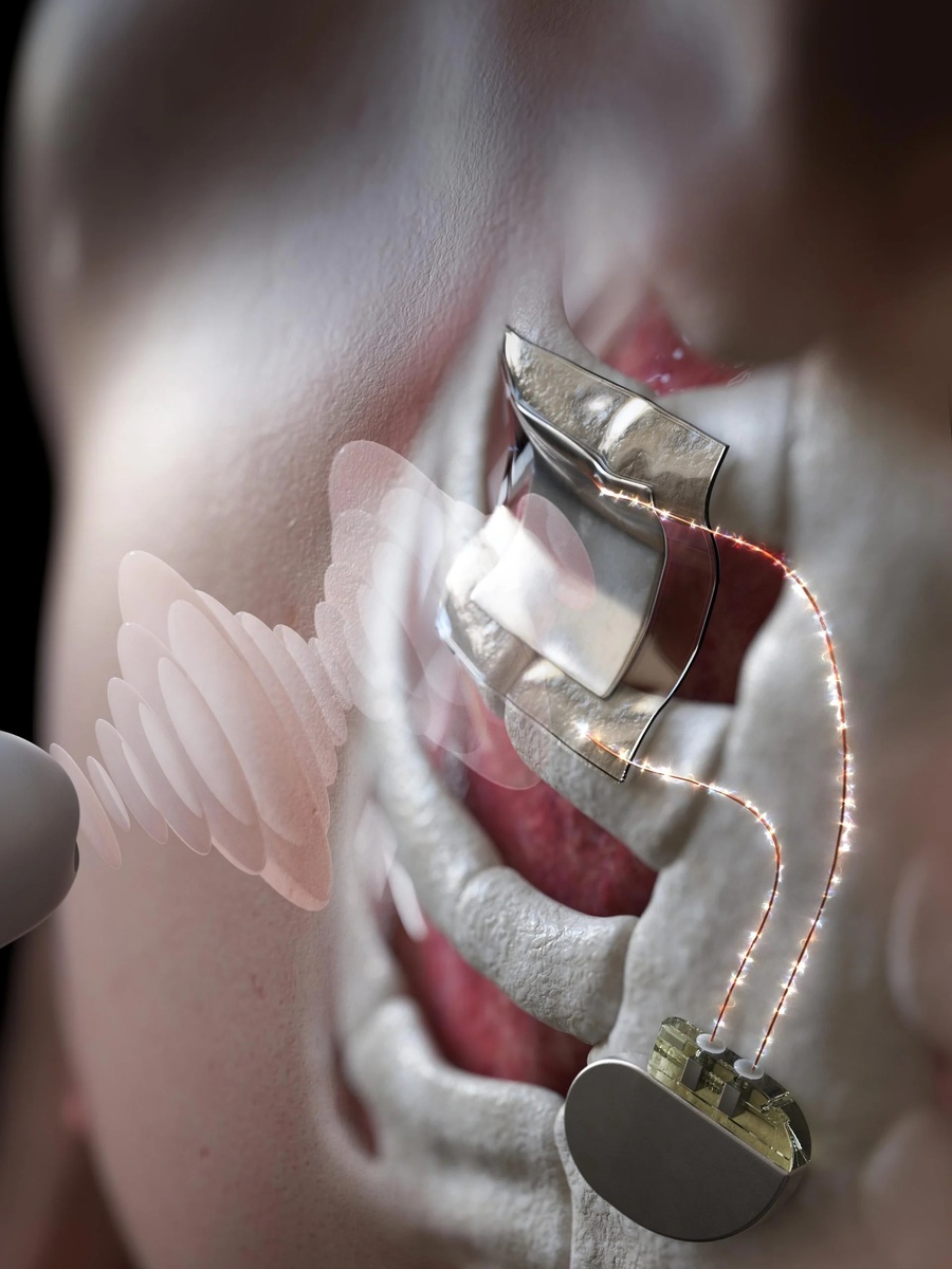 Схематическое изображение ультразвукового приемника, демонстрирующее, как он может быть согнут и деформирован в процессе беспроводной зарядки аккумулятора медицинского устройства, вставленного в тело, сохраняя при этом его работоспособность при тесном прикреплении к телу человека.