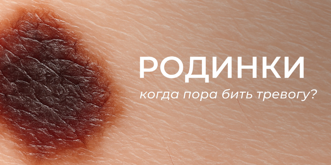 Обследование родинок — важный шаг к сохранению здоровья кожи