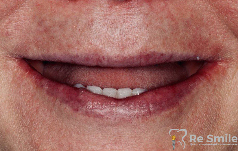 Чего не стоит делать в первую неделю, первый месяц и первые полгода после установки имплантов? Рекомендации врача